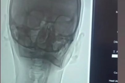 Iğdır’da şah damarı darlığına stentli müdahale
