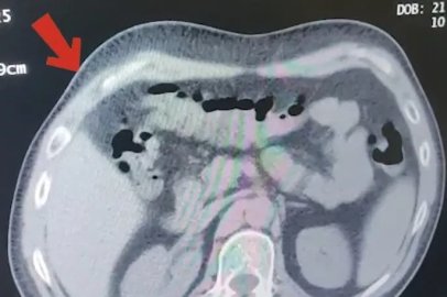 Mide ve bağırsaklarından 608 gram metamfetamin çıktı
