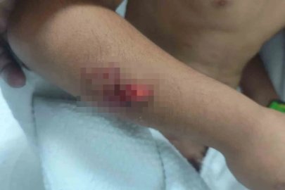 Köpek saldırısına uğrayan çocuğun başına 15 dikiş atıldı
